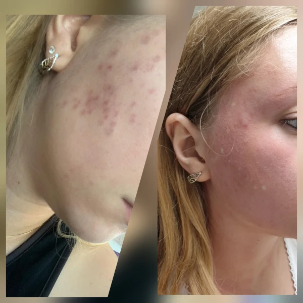 MICRONEEDLING DERMAPEN 4 M-Age