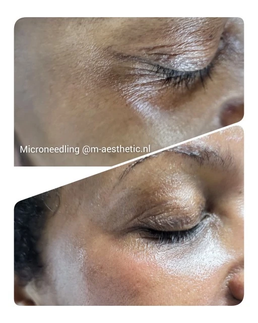 Microneedling Chitossil M-Age