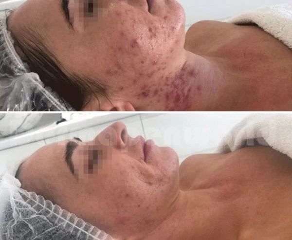 Microneedling met Exosomes M-Age