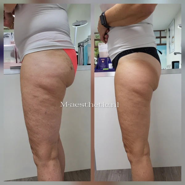 Cellulitis behandeling M-Age