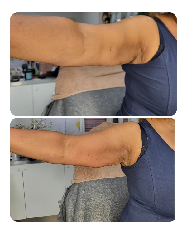 Vacuüm drainage armlift 