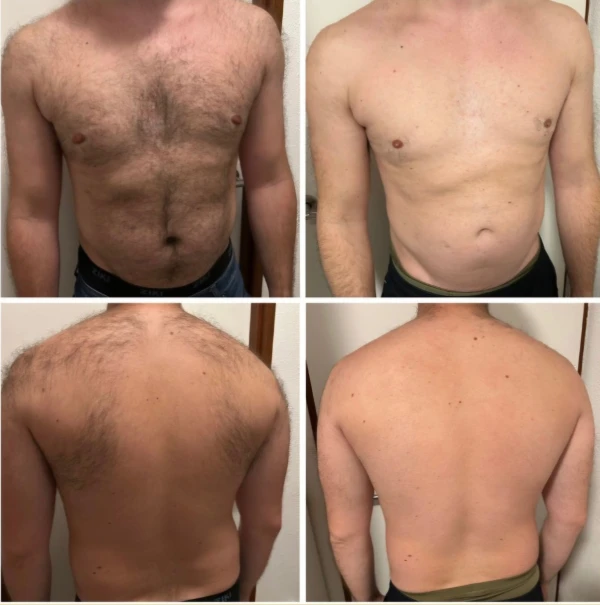 Diode Laserontharing 