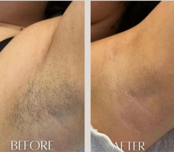 Laserontharing Den Haag|M-Age Aesthetics 