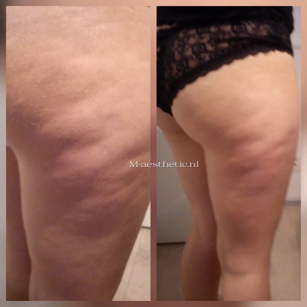RF Tripolar Cellulite bij M-Age
