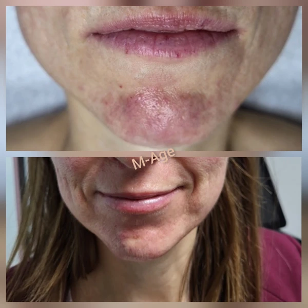 Cold Plasma M-Age Aesthetics Den Haag