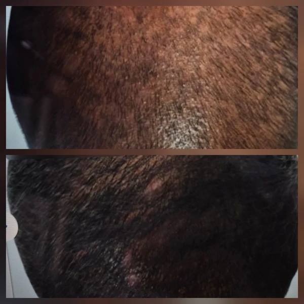 Exosomes voor Haargroei M-Age