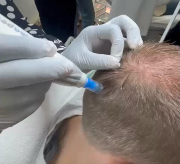 Exosomes voor Haargroei M-Age